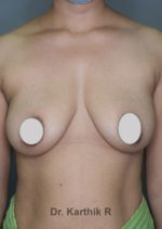 Breast Implants (Breast Augmentation)