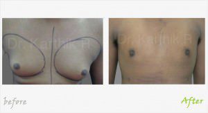 Gynecomastia Before And After