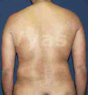 Liposuction Tummy and Back