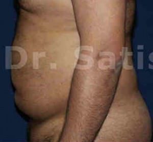 Liposuction Tummy and Back