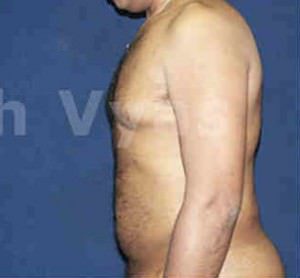Liposuction Tummy and Back