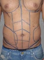 Six Packs (Abdominal etching)