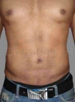 Six Packs (Abdominal etching)