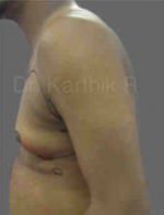 Gynecomastia (Puffy Nipples/ Male Chest Correction)
