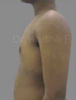 Gynecomastia (Puffy Nipples/ Male Chest Correction)