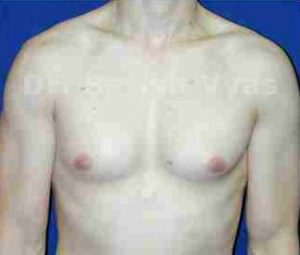 Gynecomastia (Puffy Nipples/ Male Chest Correction)
