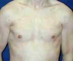 Gynecomastia (Puffy Nipples/ Male Chest Correction)