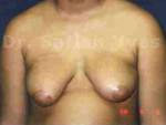 Gynecomastia (Puffy Nipples/ Male Chest Correction)