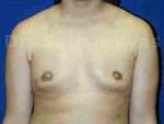 Gynecomastia (Puffy Nipples/ Male Chest Correction)