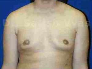 Gynecomastia (Puffy Nipples/ Male Chest Correction)
