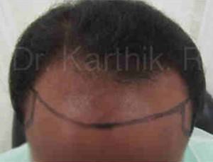 Hair Transplantation