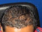 Hair Transplantation