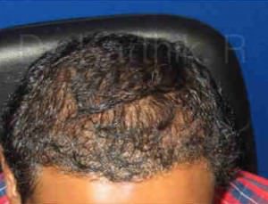 Hair Transplantation