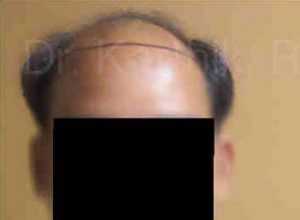 Hair Transplantation