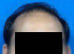 Hair Transplantation
