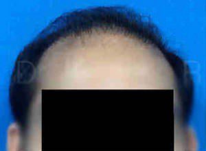Hair Transplantation