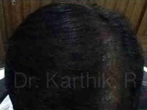 Hair Transplant