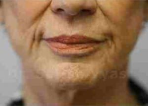 Lip Correction