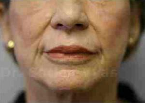 Lip Correction