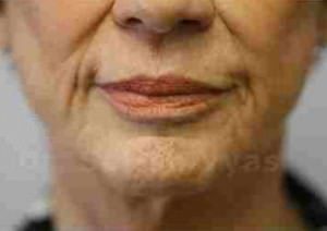 Fat Graft / Fat Fill/ Fat Transfer