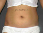 Liposuction Tummy and Back