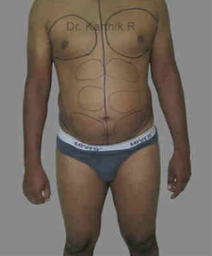 Liposuction Tummy and Back
