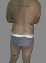 Liposuction Tummy and Back