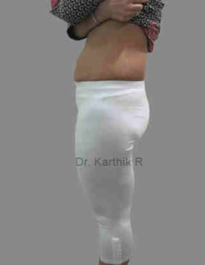 Liposuction Tummy and Back