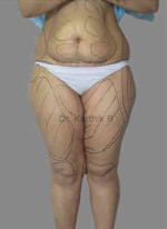 Liposuction Tummy and Back