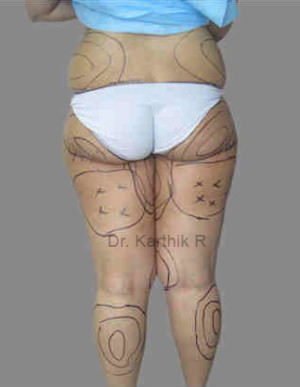 Liposuction Tummy and Back