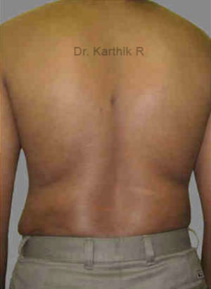 Liposuction Tummy and Back