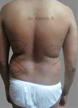 Liposuction Tummy and Back