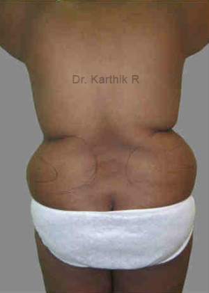 Liposuction Tummy and Back