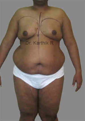 Liposuction Tummy and Back