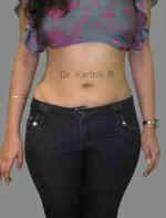 Liposuction Tummy and Back