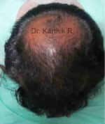 Hair Transplantation