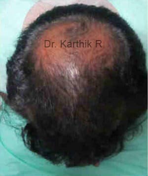 Hair Transplantation