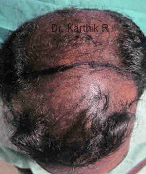Hair Transplantation