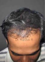 Hair Transplantation