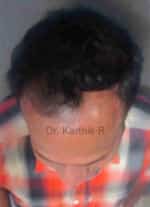 Hair Transplantation