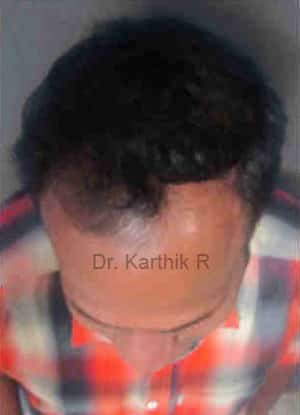 Hair Transplantation