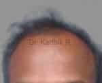 Hair Transplantation