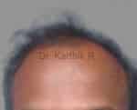 Hair Transplant