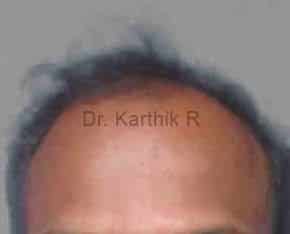 Hair Transplantation