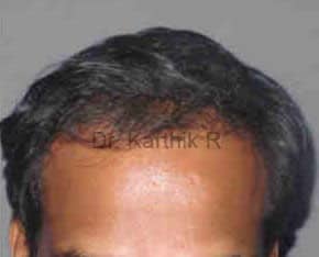 Hair Transplantation