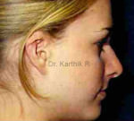 Otoplasty (Ear Correction)