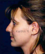 Otoplasty (Ear Correction)