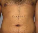 Six Packs (Abdominal etching)