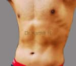 Six Packs (Abdominal etching)