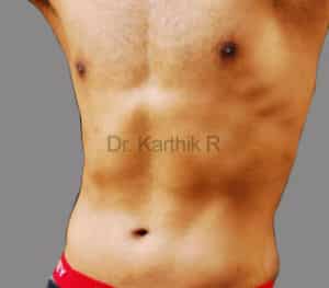 Six Packs (Abdominal etching)